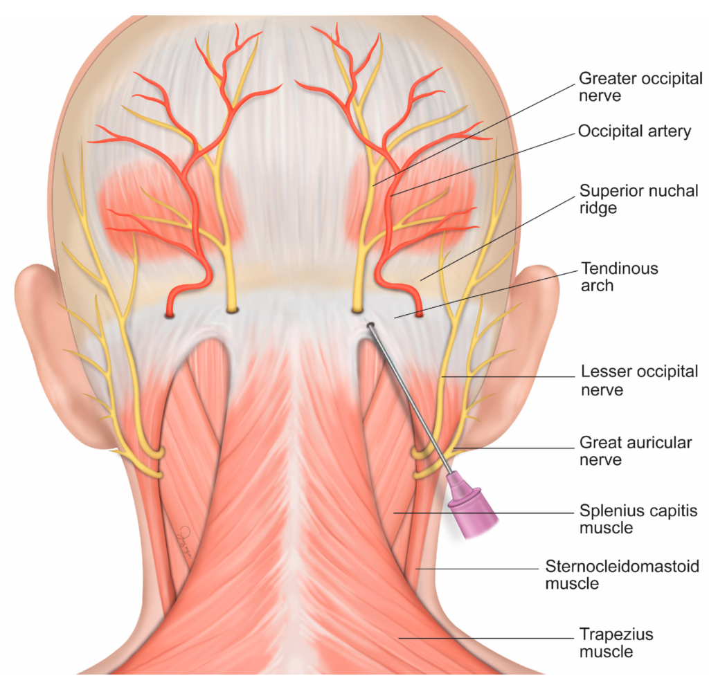 Greater Occipital Neuralgia Q Spine Greater Occipital Neuralgia Q Spine